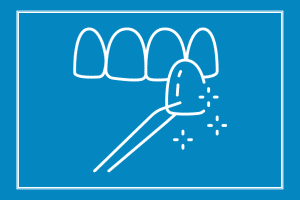 dental veneers